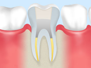 根管治療が重要な理由～美しく白い歯にする前に～