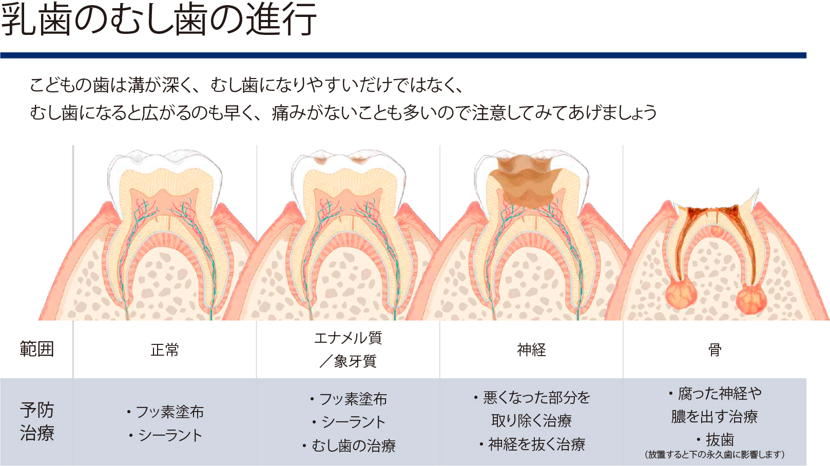乳歯のむし歯の進行