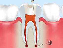 歯根（根管）のトラブル